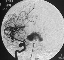 Dr.Aniruddh Kulkarni Best Neuro Surgeon Cerebral arteriovenous malformation (AVM)