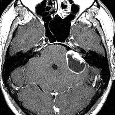 Dr.Aniruddh Kulkarni Best Neuro Surgeon Neuro surgeon trigeminal neuralgia