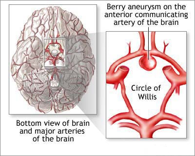 Dr.Aniruddh Kulkarni Best Neuro Surgeon Aneurysm drawing