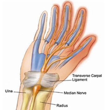 Dr.Aniruddh Kulkarni Best Neuro Surgeon Carpal Tunnel Syndrome