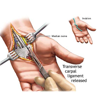 Dr.Aniruddh Kulkarni Best Neuro Surgeon Carpal Tunnel