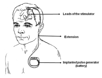 Dr.Aniruddh Kulkarni Best Neuro Surgeon shunt placement