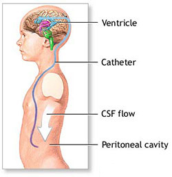 Dr.Aniruddh Kulkarni Best Neuro Surgeon shunt placement